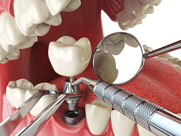 Best Urgent Tooth Repair  in Rankin, TX